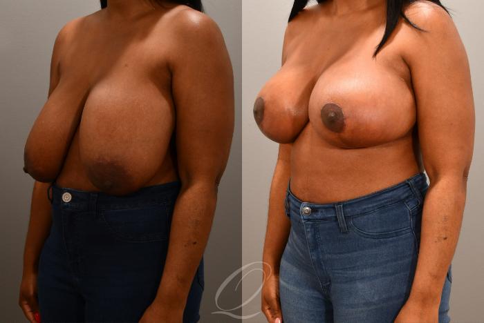 Breast Lift Case 1001630 Before & After Left Oblique | Serving Rochester, Syracuse & Buffalo, NY | Quatela Center for Plastic Surgery