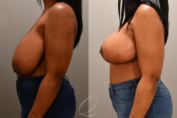 Breast Lift Case 1001630 Before & After Left Side | Serving Rochester, Syracuse & Buffalo, NY | Quatela Center for Plastic Surgery
