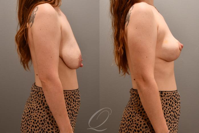 Breast Lift Case 1001631 Before & After Right Side | Serving Rochester, Syracuse & Buffalo, NY | Quatela Center for Plastic Surgery