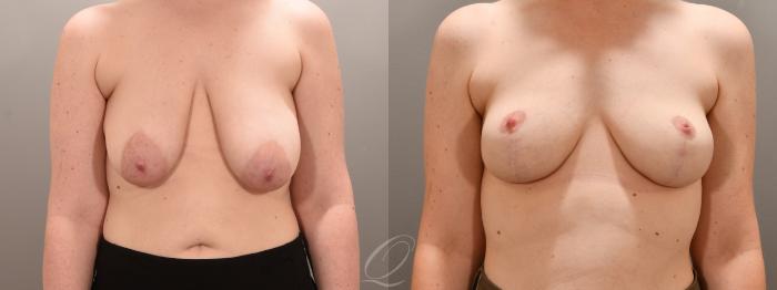 Breast Lift Case 1001632 Before & After Front | Serving Rochester, Syracuse & Buffalo, NY | Quatela Center for Plastic Surgery
