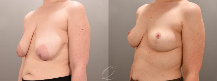 Breast Lift Case 1001632 Before & After Left Oblique | Serving Rochester, Syracuse & Buffalo, NY | Quatela Center for Plastic Surgery