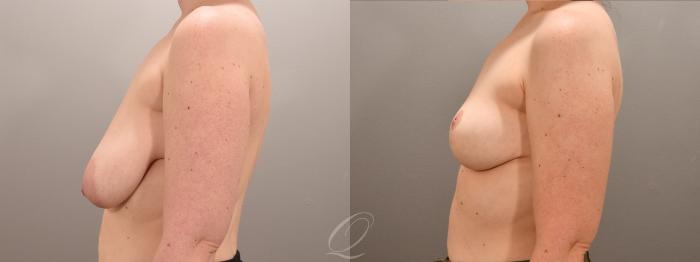 Breast Lift Case 1001632 Before & After Left Side | Serving Rochester, Syracuse & Buffalo, NY | Quatela Center for Plastic Surgery