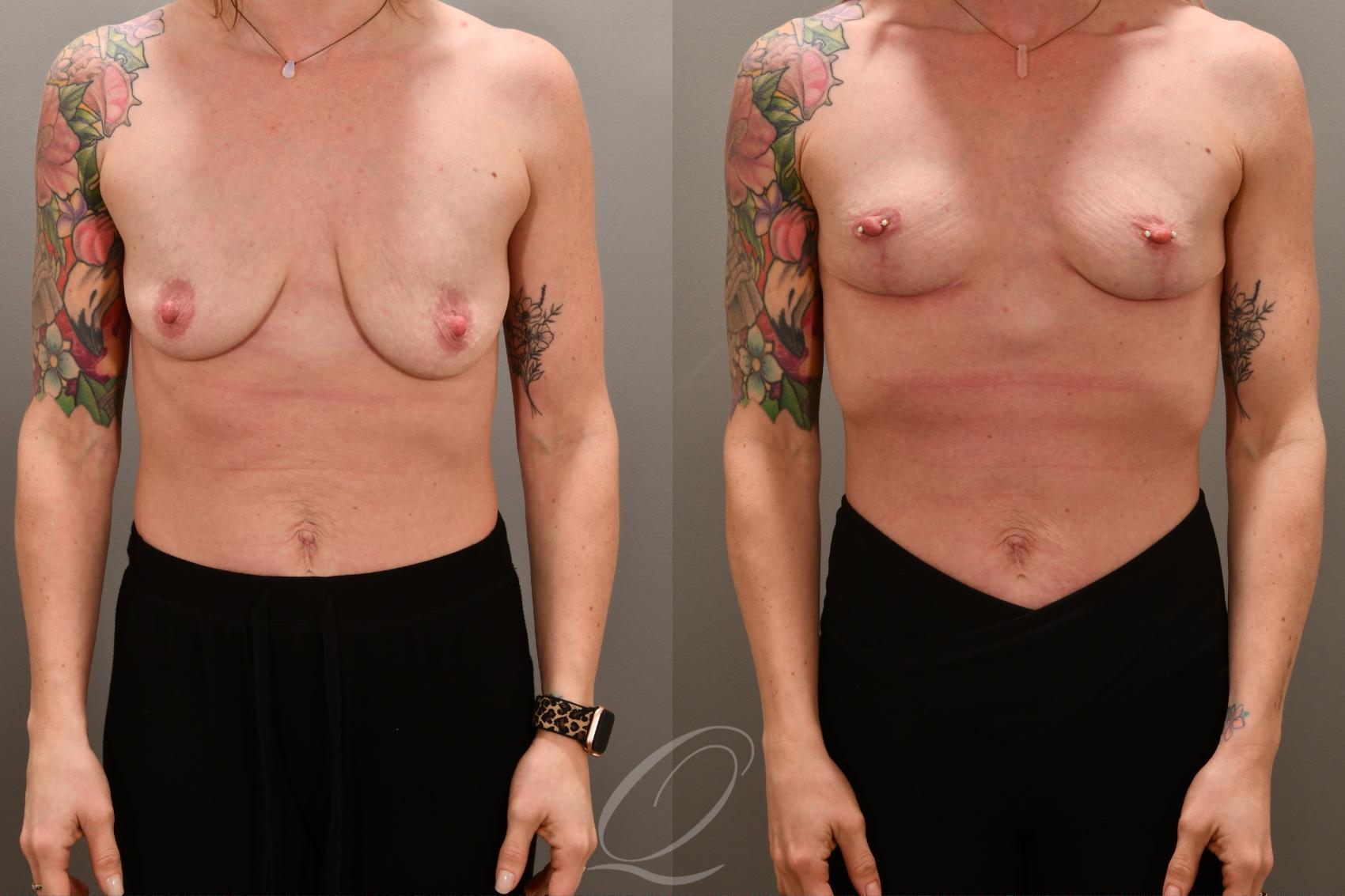 Breast Lift Case 1001676 Before & After Front | Serving Rochester, Syracuse & Buffalo, NY | Quatela Center for Plastic Surgery