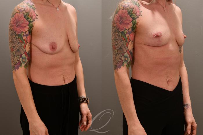 Breast Lift Case 1001676 Before & After Right Oblique | Serving Rochester, Syracuse & Buffalo, NY | Quatela Center for Plastic Surgery