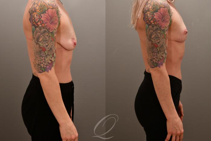 Breast Lift Case 1001676 Before & After Right Side | Serving Rochester, Syracuse & Buffalo, NY | Quatela Center for Plastic Surgery