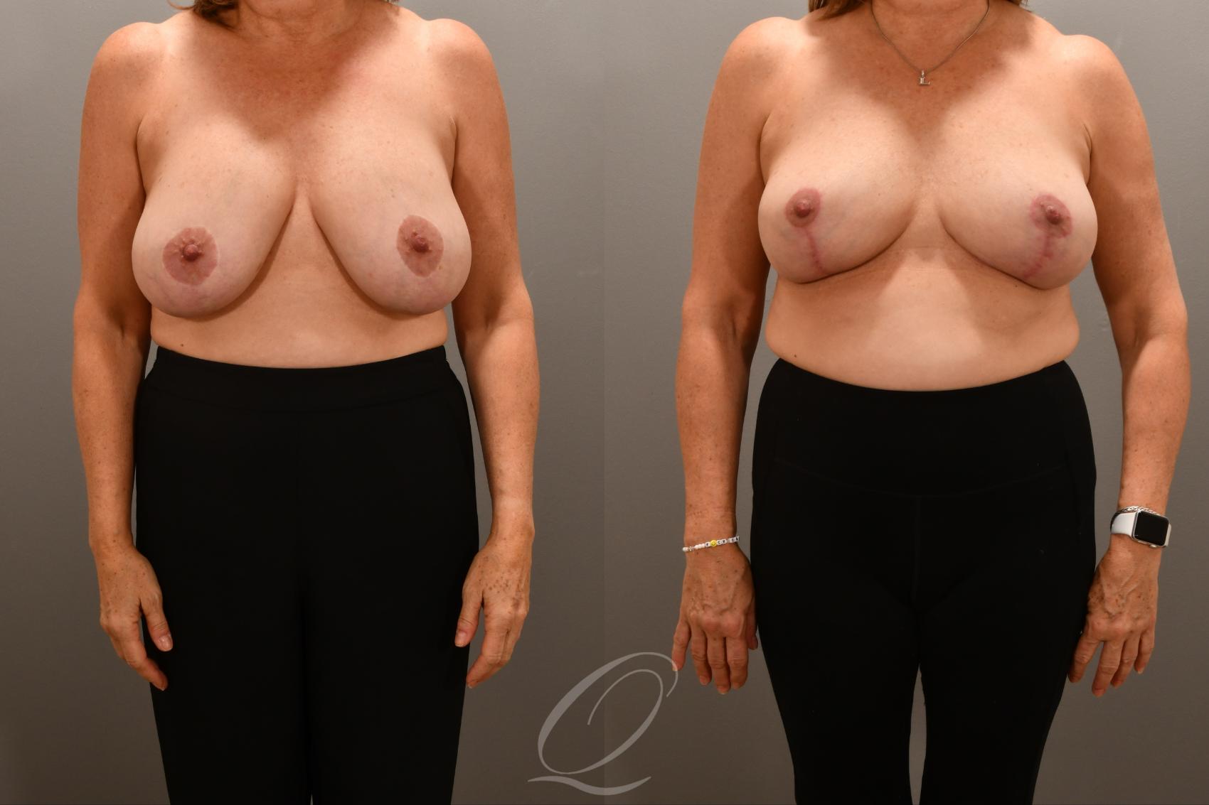 Breast Lift Case 1001718 Before & After Front | Serving Rochester, Syracuse & Buffalo, NY | Quatela Center for Plastic Surgery