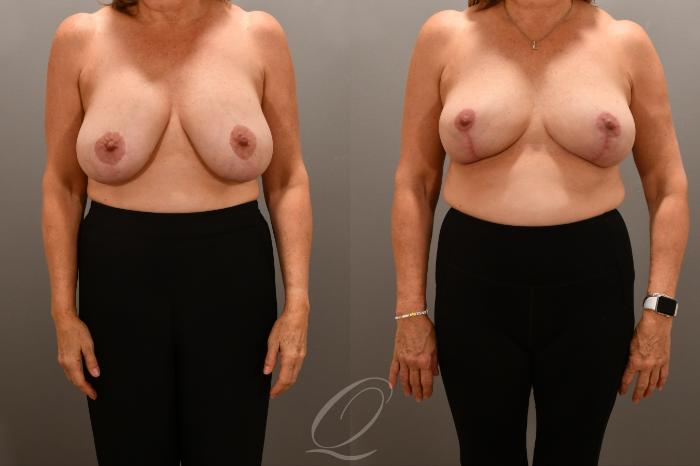 Breast Augmentation Revision Case 1001718 Before & After Front | Serving Rochester, Syracuse & Buffalo, NY | Quatela Center for Plastic Surgery