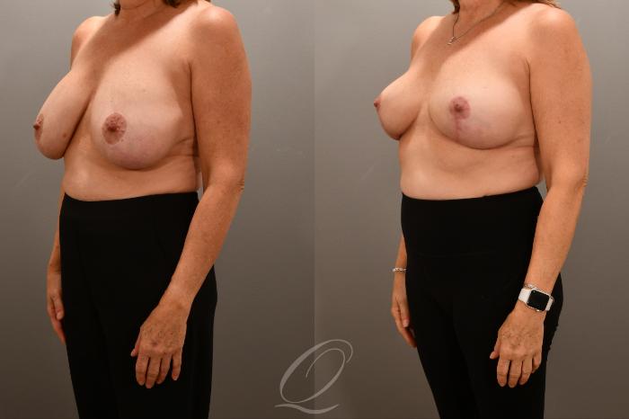 Breast Augmentation Revision Case 1001718 Before & After Left Oblique | Serving Rochester, Syracuse & Buffalo, NY | Quatela Center for Plastic Surgery