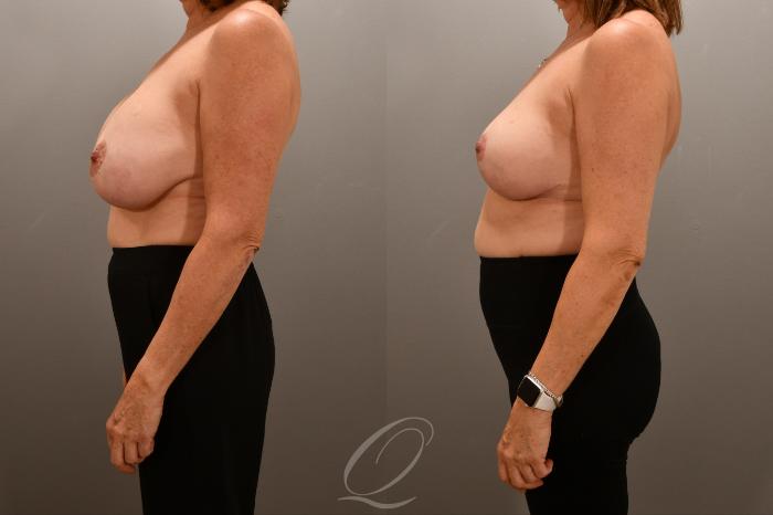 Breast Augmentation Revision Case 1001718 Before & After Left Side | Serving Rochester, Syracuse & Buffalo, NY | Quatela Center for Plastic Surgery