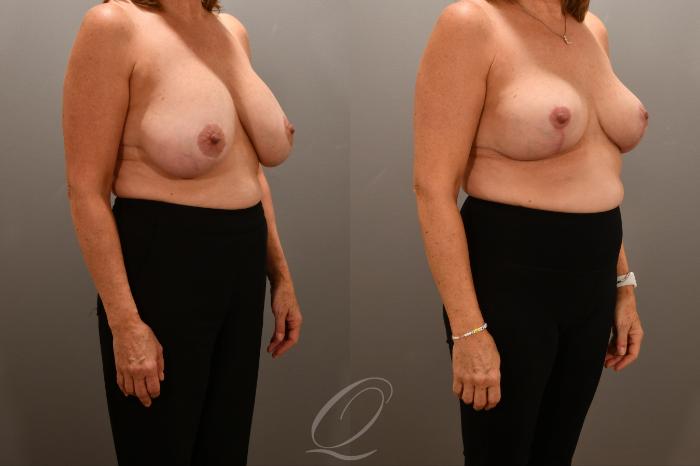 Breast Augmentation Revision Case 1001718 Before & After Right Oblique | Serving Rochester, Syracuse & Buffalo, NY | Quatela Center for Plastic Surgery