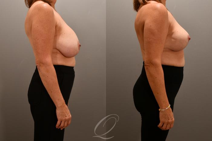 Breast Augmentation Revision Case 1001718 Before & After Right Side | Serving Rochester, Syracuse & Buffalo, NY | Quatela Center for Plastic Surgery