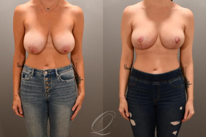 Breast Lift Case 1001741 Before & After Front | Serving Rochester, Syracuse & Buffalo, NY | Quatela Center for Plastic Surgery