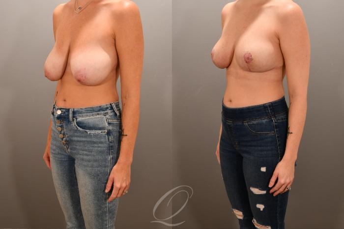 Breast Lift Case 1001741 Before & After Left Oblique | Serving Rochester, Syracuse & Buffalo, NY | Quatela Center for Plastic Surgery