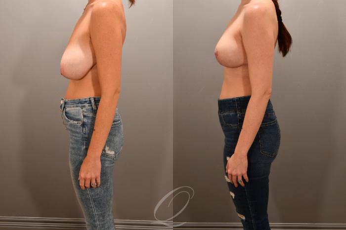 Breast Lift Case 1001741 Before & After Left Side | Serving Rochester, Syracuse & Buffalo, NY | Quatela Center for Plastic Surgery