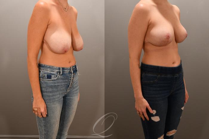 Breast Lift Case 1001741 Before & After Right Oblique | Serving Rochester, Syracuse & Buffalo, NY | Quatela Center for Plastic Surgery