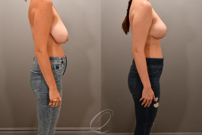 Breast Lift Case 1001741 Before & After Right Side | Serving Rochester, Syracuse & Buffalo, NY | Quatela Center for Plastic Surgery