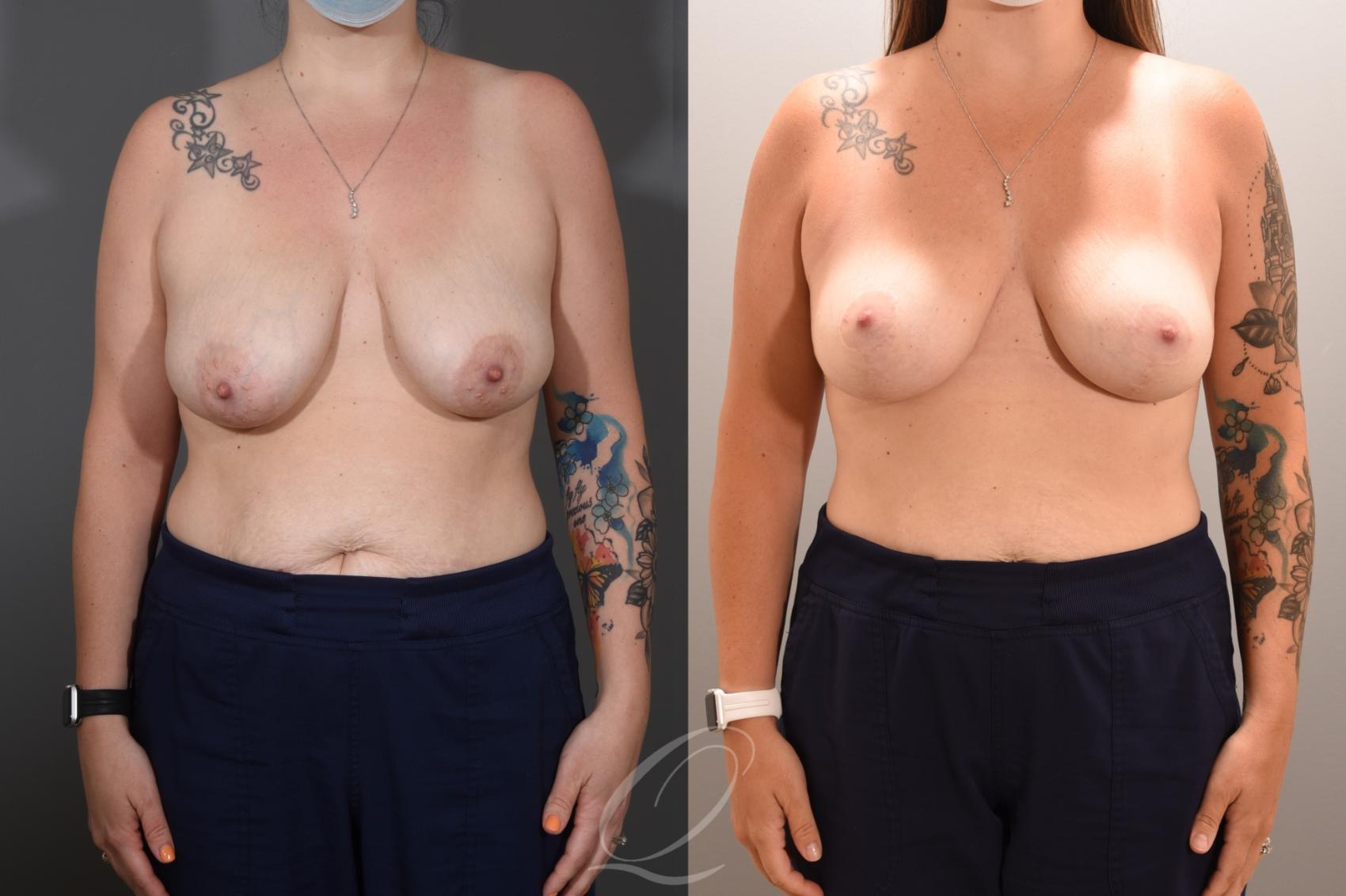 Breast Lift Case 1001768 Before & After Front | Serving Rochester, Syracuse & Buffalo, NY | Quatela Center for Plastic Surgery