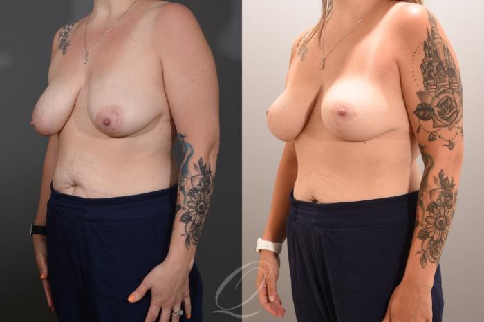 Breast Lift Case 1001768 Before & After Left Oblique | Serving Rochester, Syracuse & Buffalo, NY | Quatela Center for Plastic Surgery