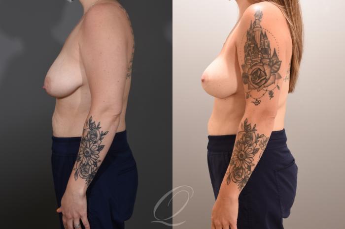 Breast Lift Case 1001768 Before & After Left Side | Serving Rochester, Syracuse & Buffalo, NY | Quatela Center for Plastic Surgery