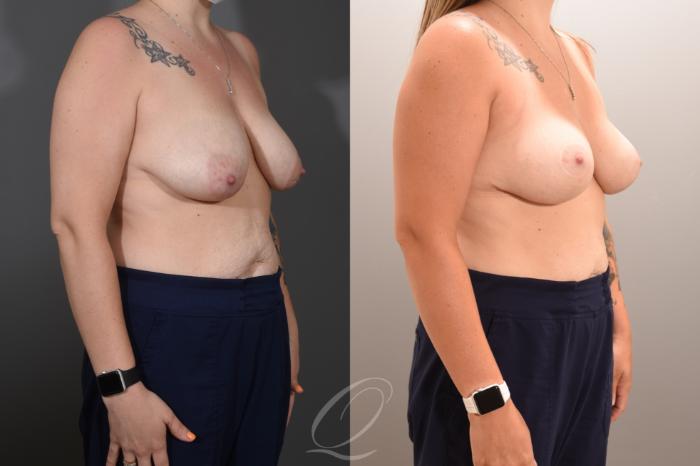 Breast Lift Case 1001768 Before & After Right Oblique | Serving Rochester, Syracuse & Buffalo, NY | Quatela Center for Plastic Surgery