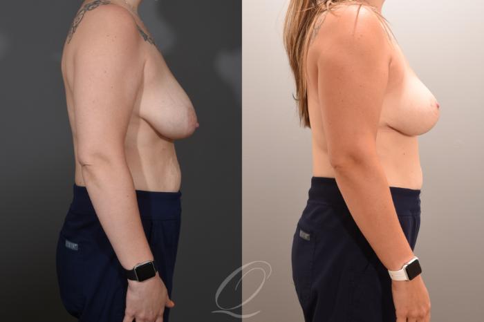 Breast Lift Case 1001768 Before & After Right Side | Serving Rochester, Syracuse & Buffalo, NY | Quatela Center for Plastic Surgery