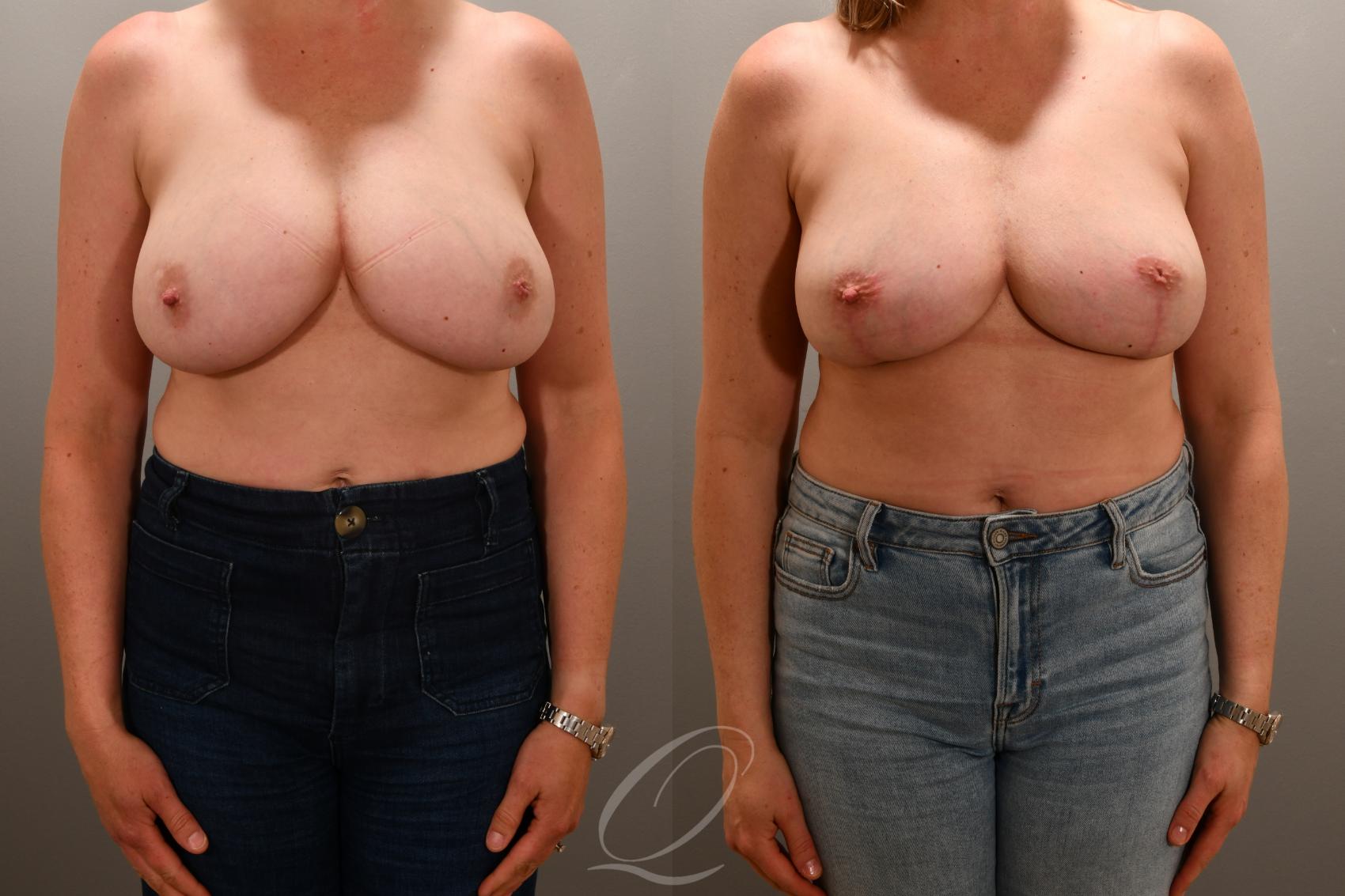 Breast Lift Case 1001769 Before & After Front | Serving Rochester, Syracuse & Buffalo, NY | Quatela Center for Plastic Surgery