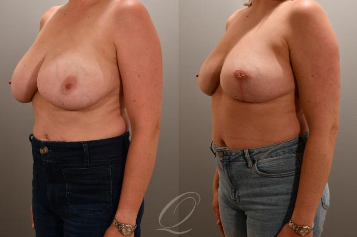 Breast Lift Case 1001769 Before & After Left Oblique | Serving Rochester, Syracuse & Buffalo, NY | Quatela Center for Plastic Surgery