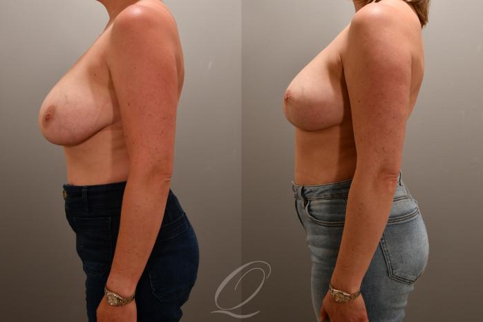 Breast Lift Case 1001769 Before & After Left Side | Serving Rochester, Syracuse & Buffalo, NY | Quatela Center for Plastic Surgery