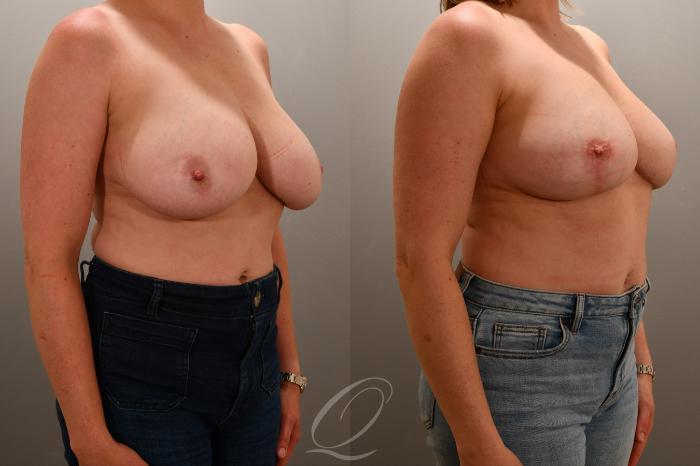 Breast Lift Case 1001769 Before & After Right Oblique | Serving Rochester, Syracuse & Buffalo, NY | Quatela Center for Plastic Surgery