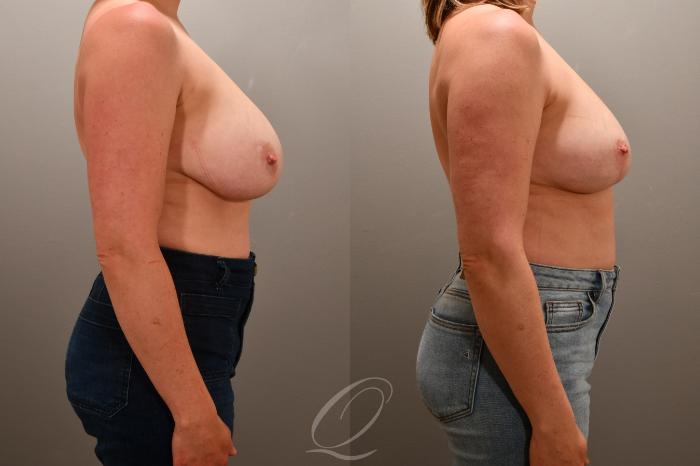 Breast Lift Case 1001769 Before & After Right Side | Serving Rochester, Syracuse & Buffalo, NY | Quatela Center for Plastic Surgery