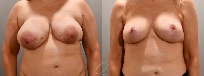 Breast Lift Case 1001780 Before & After Front | Serving Rochester, Syracuse & Buffalo, NY | Quatela Center for Plastic Surgery