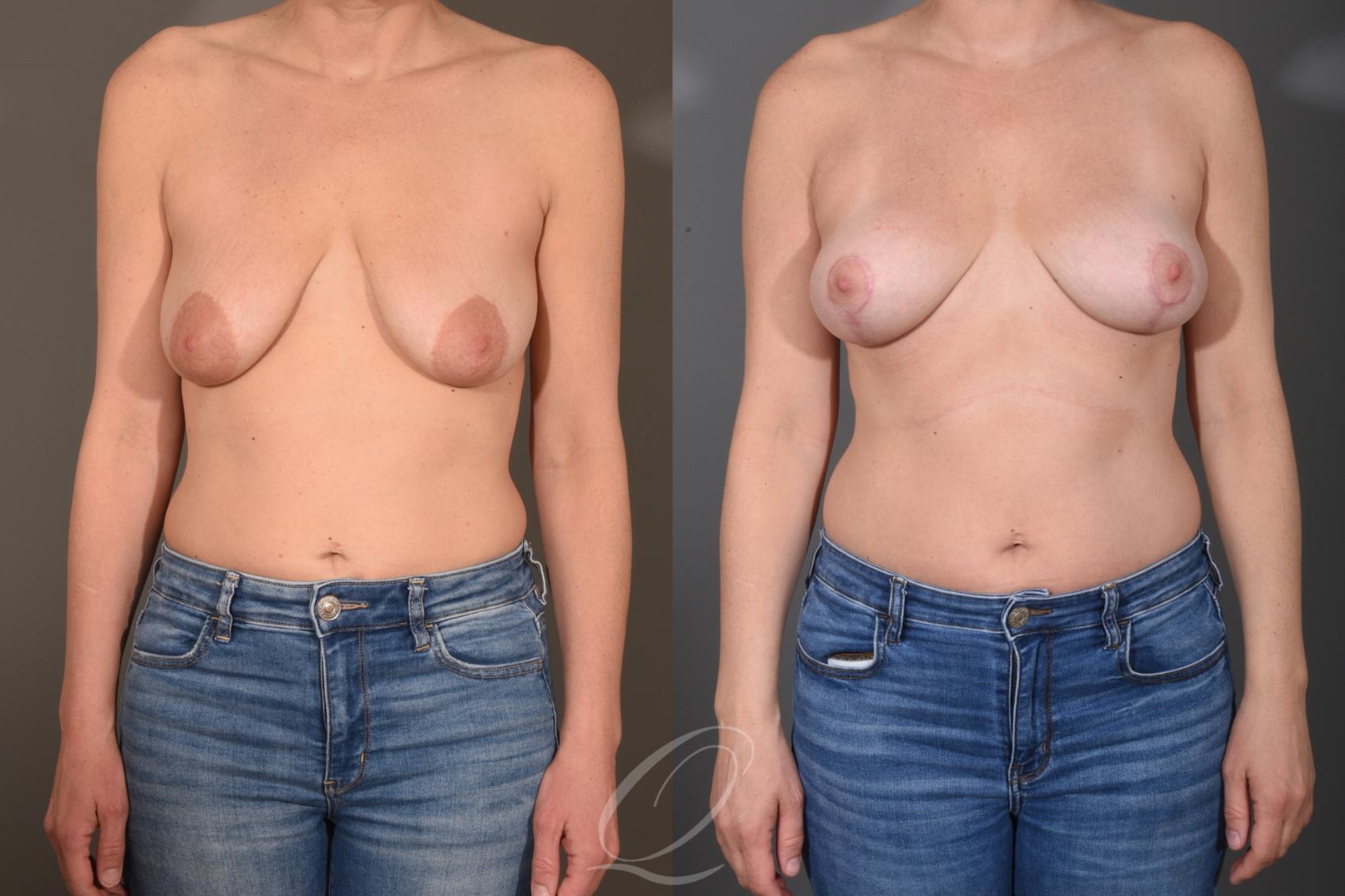 Breast Lift Case 1001782 Before & After Front | Serving Rochester, Syracuse & Buffalo, NY | Quatela Center for Plastic Surgery