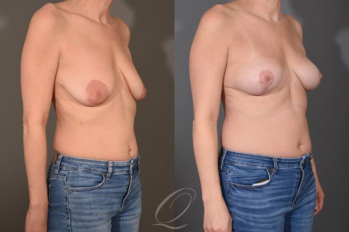 Breast Lift Case 1001782 Before & After Right Oblique | Serving Rochester, Syracuse & Buffalo, NY | Quatela Center for Plastic Surgery