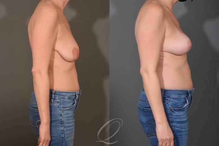 Breast Lift Case 1001782 Before & After Right Side | Serving Rochester, Syracuse & Buffalo, NY | Quatela Center for Plastic Surgery