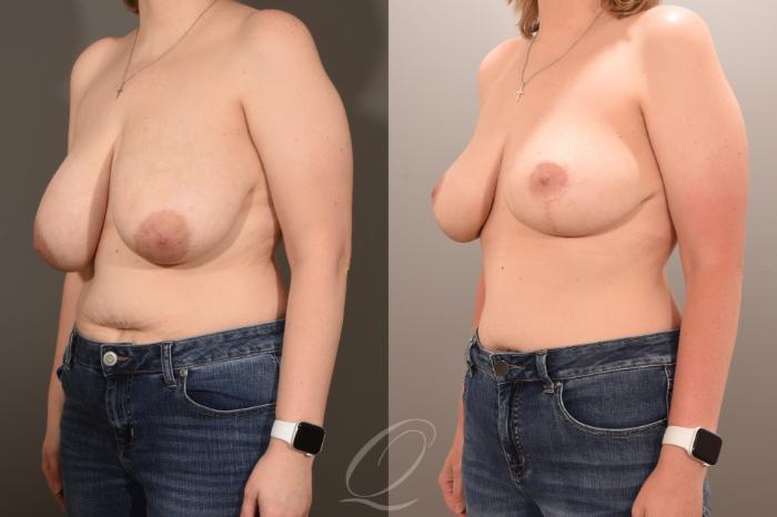 Breast Lift Case 1001783 Before & After Left Oblique | Serving Rochester, Syracuse & Buffalo, NY | Quatela Center for Plastic Surgery