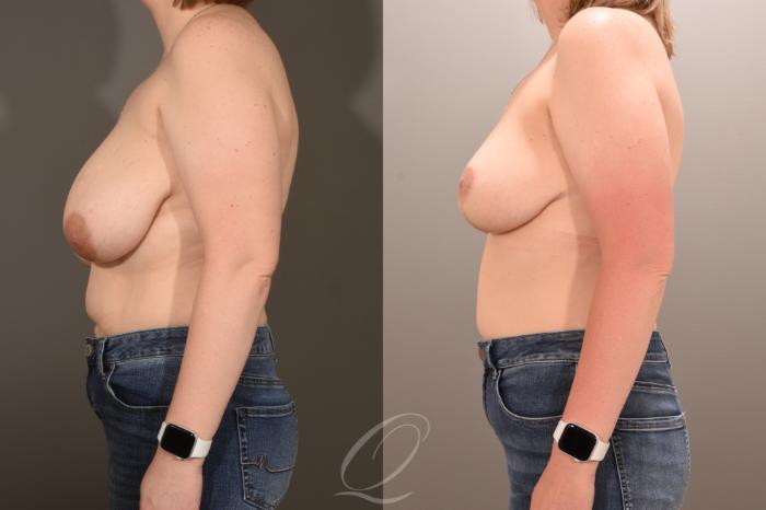 Breast Lift Case 1001783 Before & After Left Side | Serving Rochester, Syracuse & Buffalo, NY | Quatela Center for Plastic Surgery