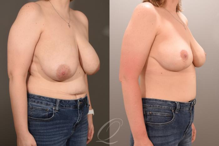 Breast Lift Case 1001783 Before & After Right Oblique | Serving Rochester, Syracuse & Buffalo, NY | Quatela Center for Plastic Surgery