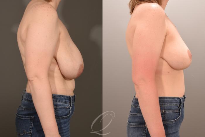 Breast Lift Case 1001783 Before & After Right Side | Serving Rochester, Syracuse & Buffalo, NY | Quatela Center for Plastic Surgery