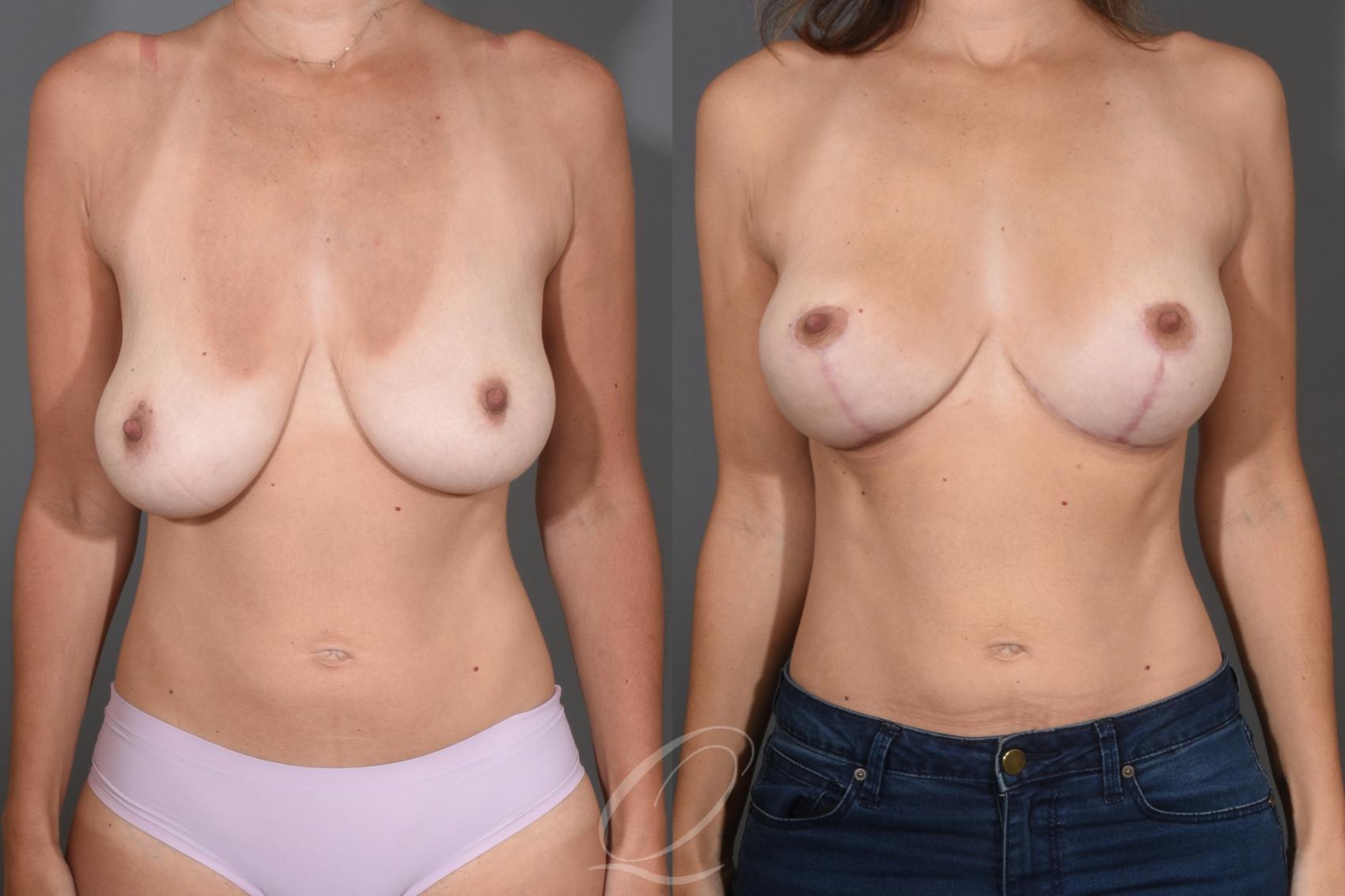 Breast Lift Case 1001784 Before & After Front | Serving Rochester, Syracuse & Buffalo, NY | Quatela Center for Plastic Surgery