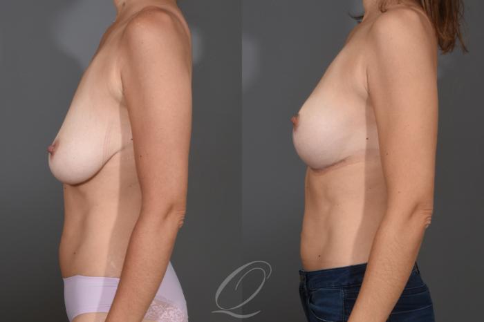 Breast Lift Case 1001784 Before & After Left Side | Serving Rochester, Syracuse & Buffalo, NY | Quatela Center for Plastic Surgery