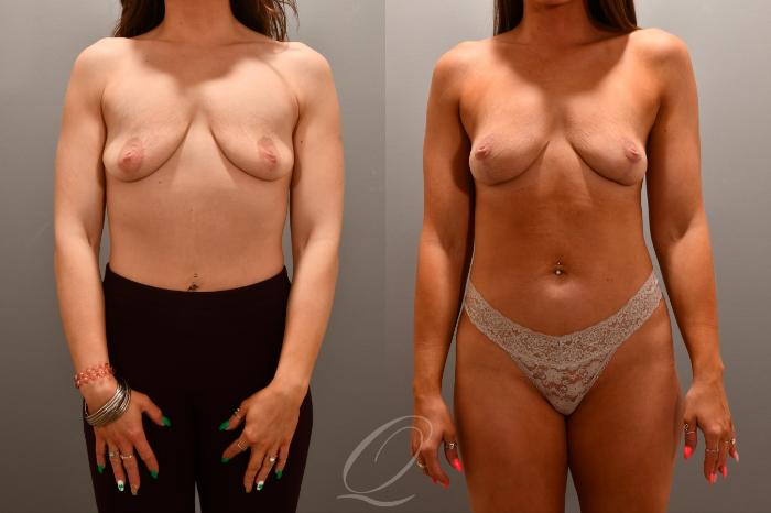 Breast Lift Case 1001785 Before & After Front | Serving Rochester, Syracuse & Buffalo, NY | Quatela Center for Plastic Surgery