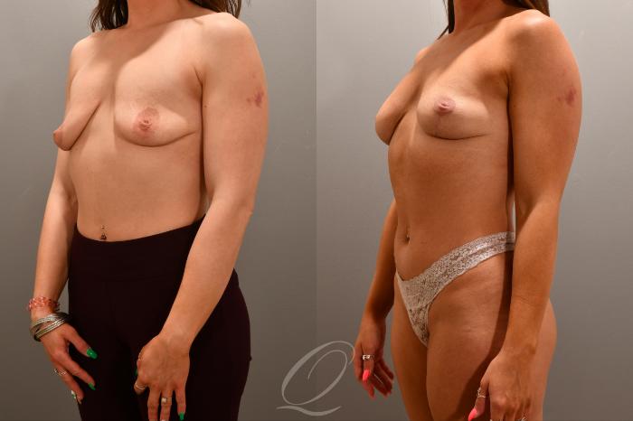 Breast Lift Case 1001785 Before & After Left Oblique | Serving Rochester, Syracuse & Buffalo, NY | Quatela Center for Plastic Surgery