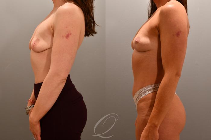 Breast Lift Case 1001785 Before & After Left Side | Serving Rochester, Syracuse & Buffalo, NY | Quatela Center for Plastic Surgery