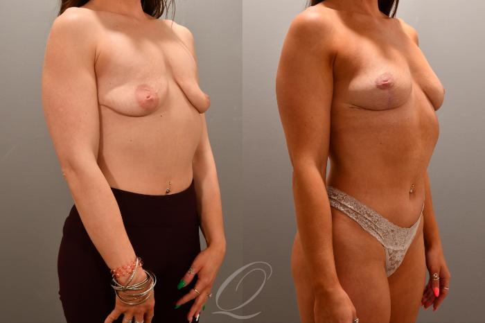 Breast Lift Case 1001785 Before & After Right Oblique | Serving Rochester, Syracuse & Buffalo, NY | Quatela Center for Plastic Surgery