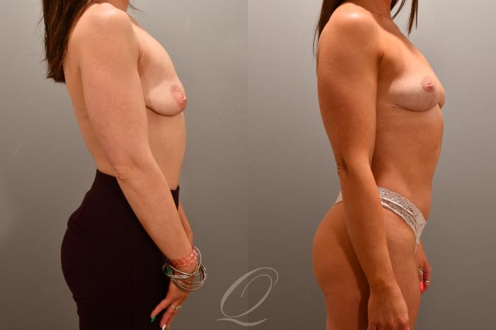 Breast Lift Case 1001785 Before & After Right Side | Serving Rochester, Syracuse & Buffalo, NY | Quatela Center for Plastic Surgery