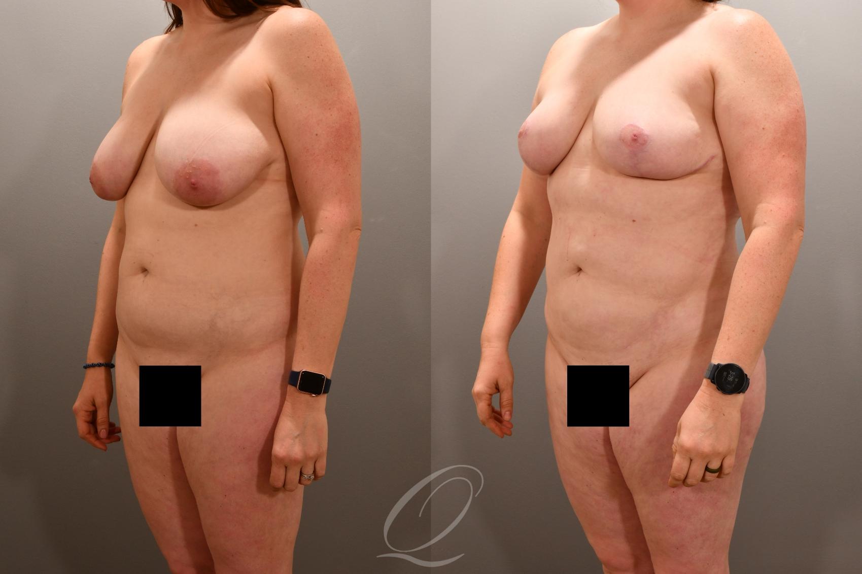 Liposuction Case 1001865 Before & After Left Oblique | Serving Rochester, Syracuse & Buffalo, NY | Quatela Center for Plastic Surgery