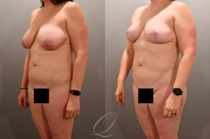 Liposuction Case 1001865 Before & After Left Oblique | Serving Rochester, Syracuse & Buffalo, NY | Quatela Center for Plastic Surgery