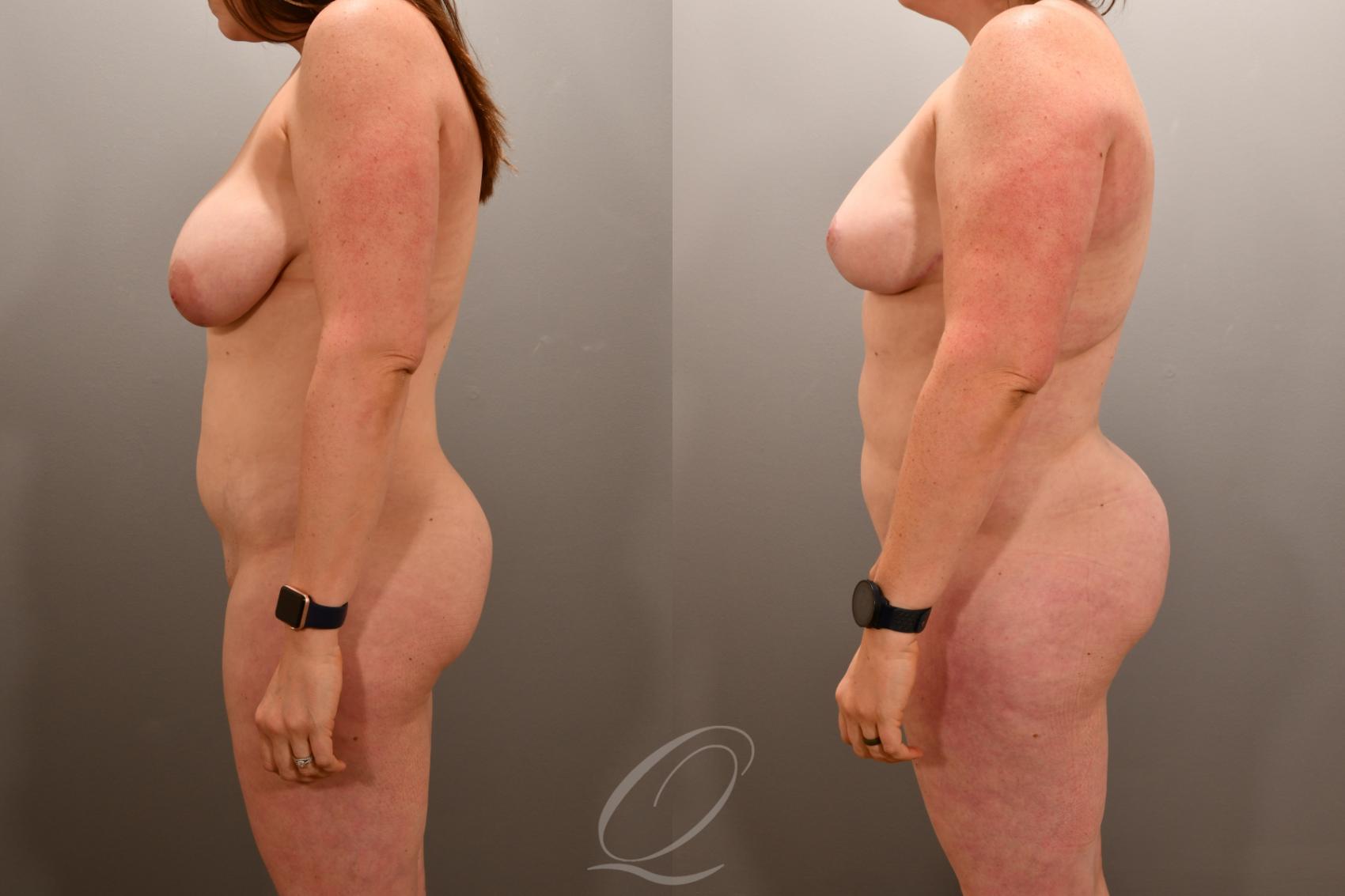 Liposuction Case 1001865 Before & After Left Side | Serving Rochester, Syracuse & Buffalo, NY | Quatela Center for Plastic Surgery