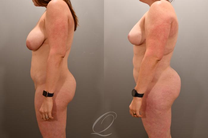 Liposuction Case 1001865 Before & After Left Side | Serving Rochester, Syracuse & Buffalo, NY | Quatela Center for Plastic Surgery