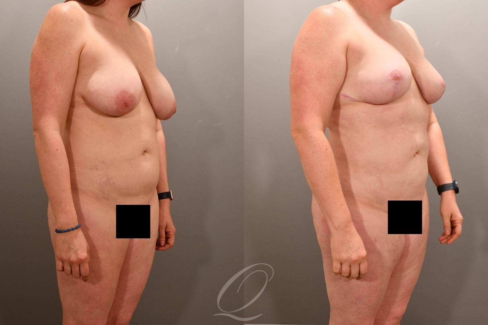 Liposuction Case 1001865 Before & After Right Oblique | Serving Rochester, Syracuse & Buffalo, NY | Quatela Center for Plastic Surgery